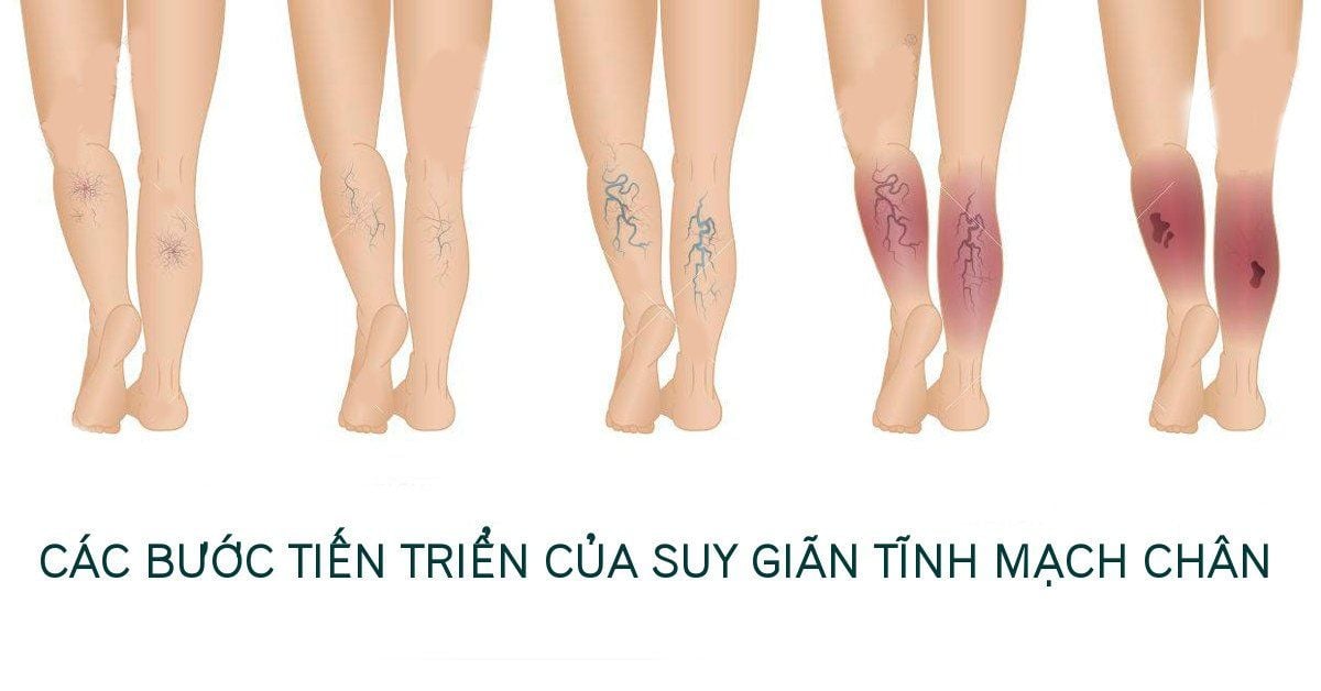 Yếu tố nguy cơ mắc bệnh suy giãn tĩnh mạch chân